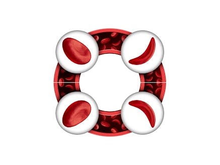 Sickle Cell